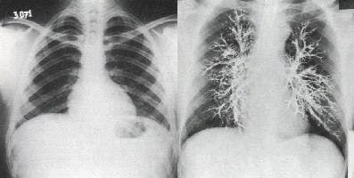 Sovradistensione polmonare